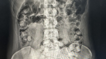 2泰女吞食115顆海洛英來台 入境遭攔截送辦