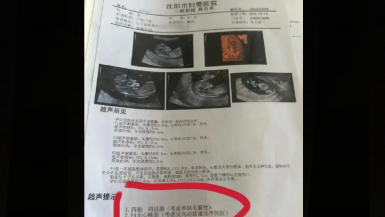 中國女子產檢1次多1胎 罕見懷同卵四胞胎