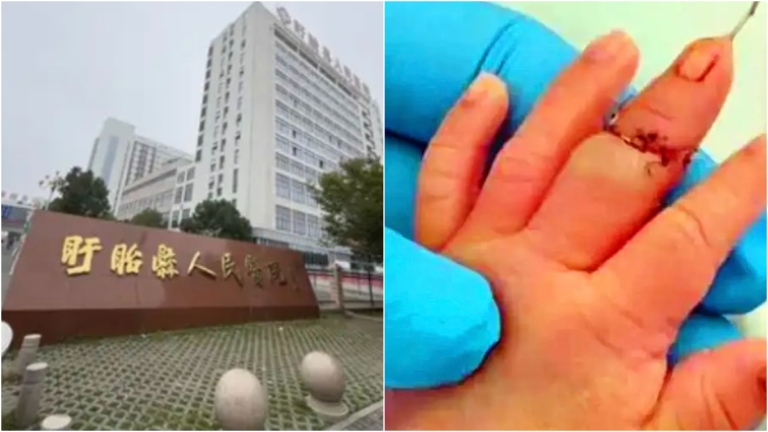 江蘇一新生兒剪臍帶時被剪斷手指 被質疑故意傷害