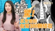【健康1+1】惊！真实案例 右肾300颗结石