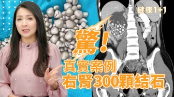 【健康1+1】驚！真實案例 右腎300顆結石