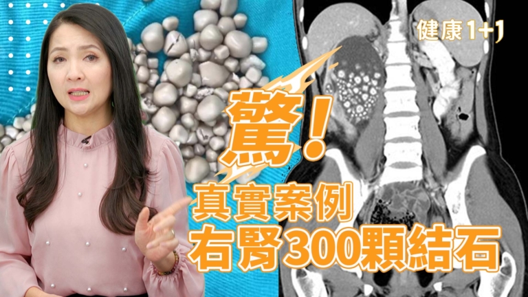 【健康1+1】驚！真實案例 右腎300顆結石