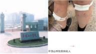 河南女大學生遭群狗咬傷20多處 惡犬仍校內遊蕩