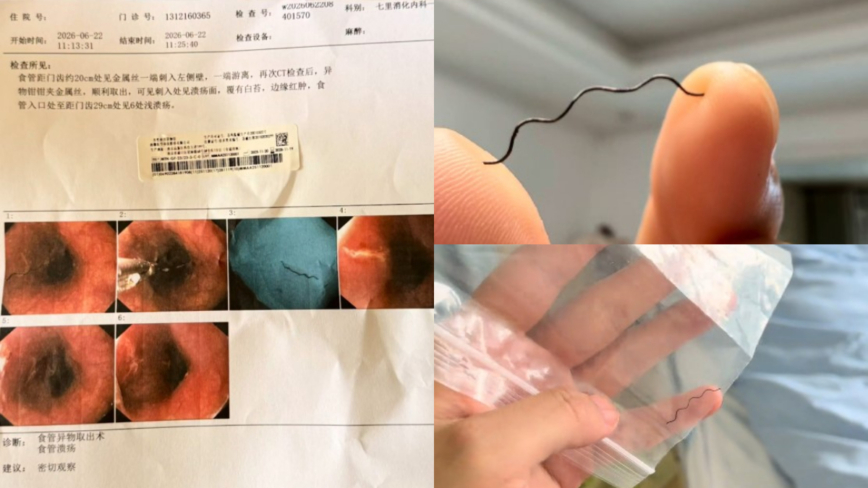 恐怖!女子吃火鍋吞2.2厘米硬鐵絲 喉嚨劃傷(視頻)