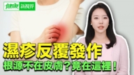 【健康新视界】湿疹反复发作 根源不在皮肤?