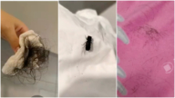 理髮虱?廣西女子睡覺被蟲咬斷大把頭髮