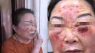 中国73岁女子花逾万元做医美 惨遭毁容（慎入）