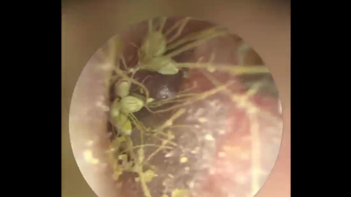 1歲幼童頻抓撓耳朵 耳道內驚見植物種子發芽