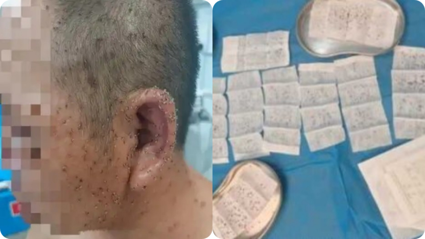 惊悚！男子遭蜂群围攻 全身残留近千根毒刺